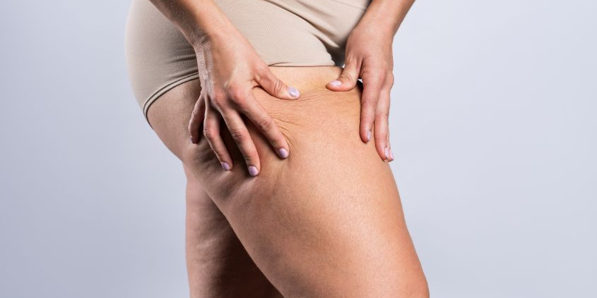 Behandlung bei Lipödem: Wie Sie Schwellungen und Schmerzen lindern